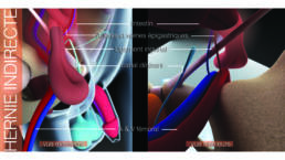 Fiche patient Hernie en 3D