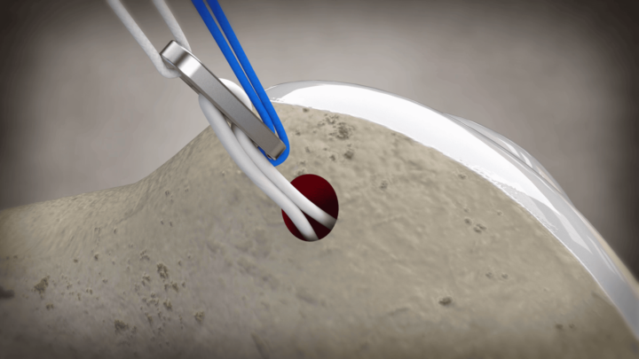 endo bouton plaque sur fémur simulation passage transplant collaboration chirurgien