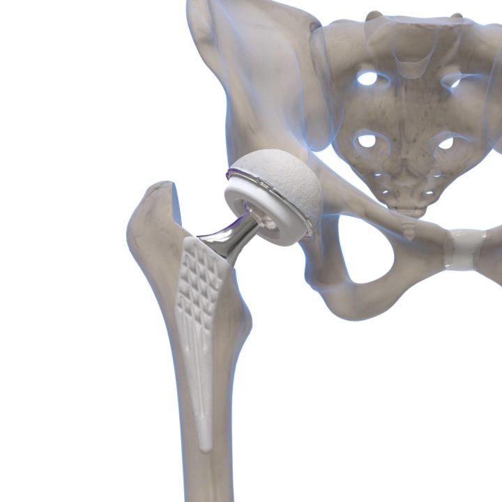 prothèse de hanche rayon X dedienne santé pour publicité site web