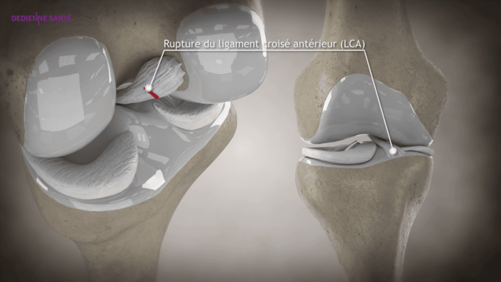rupture du ligaments LCA dedienne santé