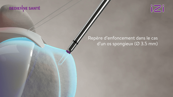 enfoncement vu rayon X technique opératoire epaule
