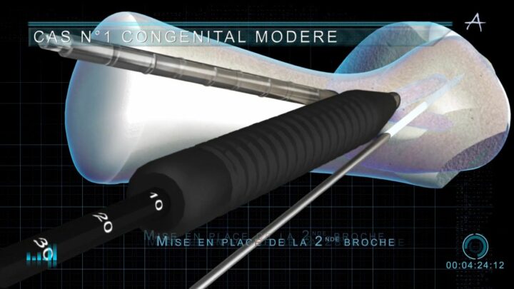 détails technique opératoire chirurgie film pédagogique sciences